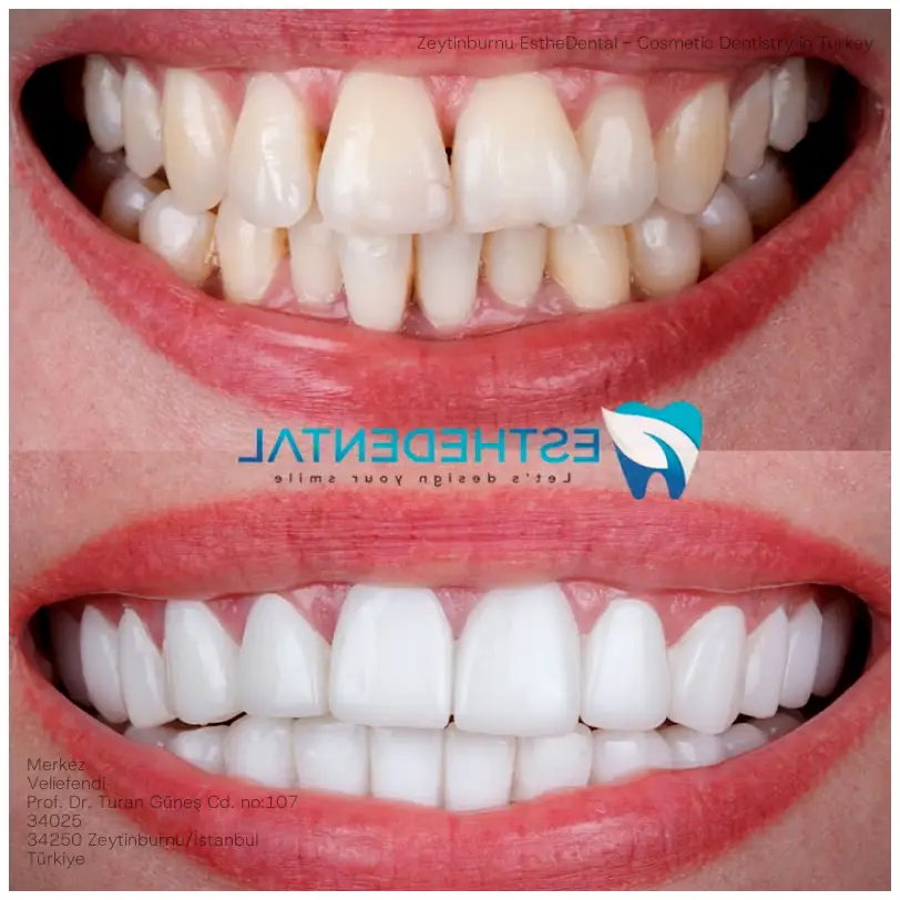 Zeytinburnu EstheDental - Cosmetic Dentistry in Turkey